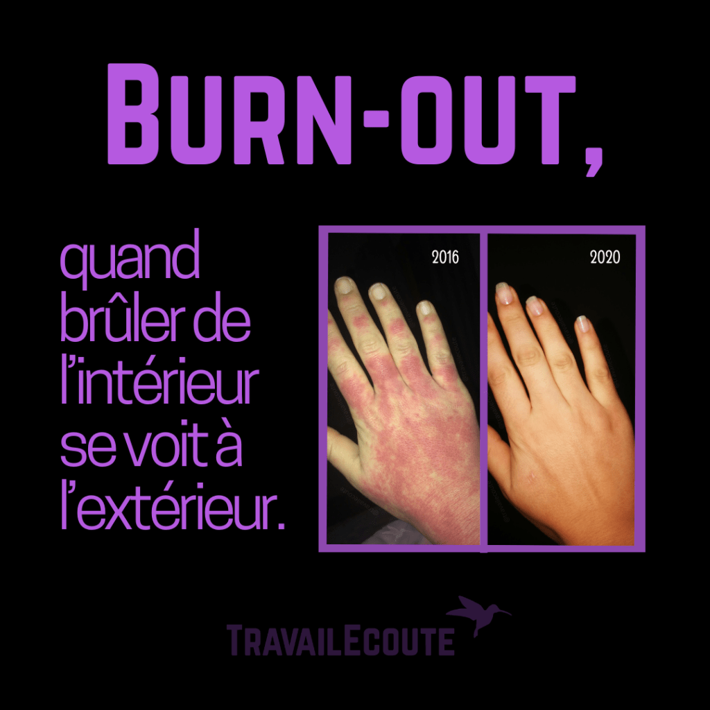 Mon burn-out et ses symptômes physiques.